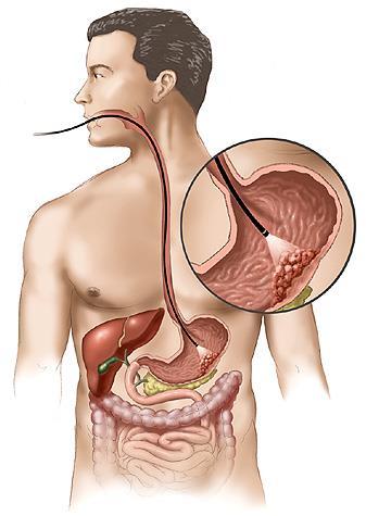 Nádory žaludku benigní vzácné maligní lymfom rovněž v tenkém a tlustém střevě karcinoid také ve střevě, pankreatu, bronších a plicích karcinom ohraničený x difuzní etiologie složení stravy!