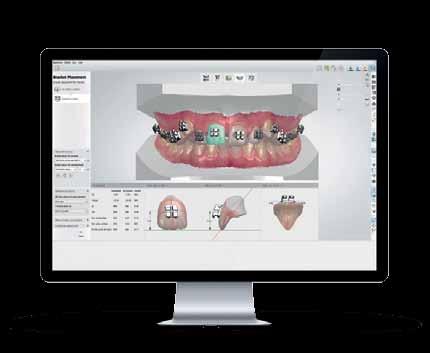 Diagnostické analýzy Plánování léčby Nepřímé lepení Virtuální setup a