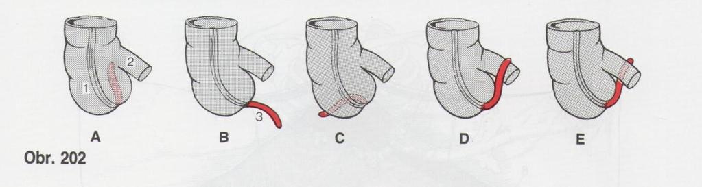 uložení apendixu 1.) typické ileocaecalis subcaecalis praecaecalis laterocaecalis retrocaecalis positio pelvina 2.