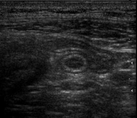 appendix vermiformis - epityphlon def.