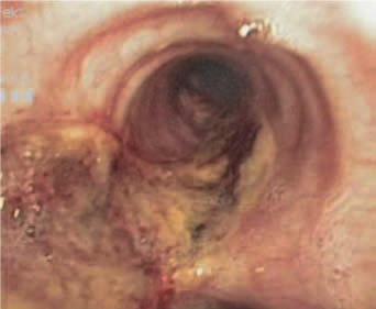 Co mohou skrývat dýchací cesty u granulomatózy s polyangiitidou (Wegenerovy granulomatózy) s postižením ledvin Obr. č.