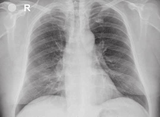 č. 18). Bronchoskopické vyšetření: průsvit středního lobárního bronchu štěrbinovitě zúžený, z periferie byl patrný výron šedobílého sekretu (obr. č. 19/1,2).