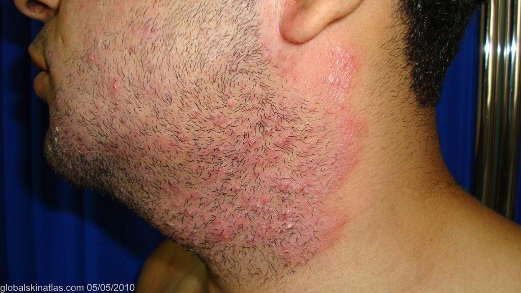 26 3.3.2 Tinea barbae Tinea barbae (viz Obr. 3.2) je dermatofytická infekce vousy pokryté části obličeje a krku.