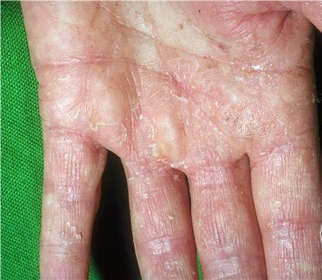 29 3.3.5 Tinea manus Tinea manus (viz Obr. 3.6) je méně častá dermatofytická infekce ruky. Klinický obraz závisí na lokalizaci nákazy a reakci organismu.