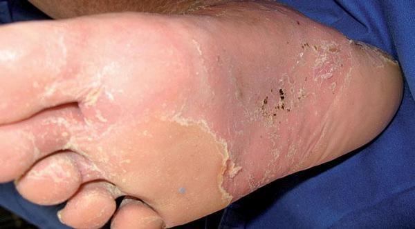 31 Obr. 3.7 Tinea pedis intertriginózní forma Převzato z: http://dermatology.about.com/ Skvamózně - hyperkeratotická forma postihuje hlavně okraje nohy, paty a konečky prstů.