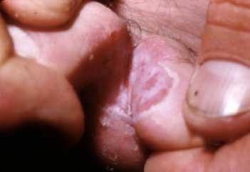 U všech forem tinea pedis jsou často postiženy i nehty, což je hlavním diagnostickým symptomem. (Braun-Falco et al. 2001) Dyshidrotická vezikulo-bulózní forma (viz Obr. 3.8) je nejméně častá.