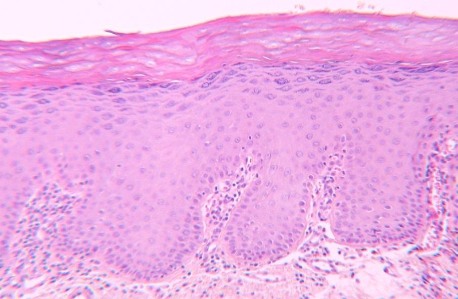 Hyperkeratóza v histologii - ztluštění keratinové vrstvy nad