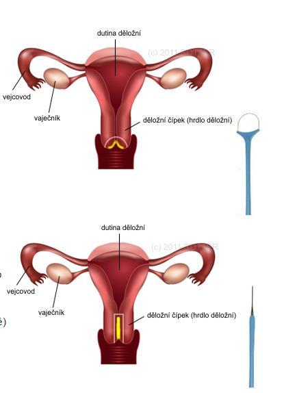Konizace děložního čípku Krátký zákrok s odstraněním postižené části čípku Rozsah dle možností k zachování těhotenství Trachelektomie prostá či radikální u žen