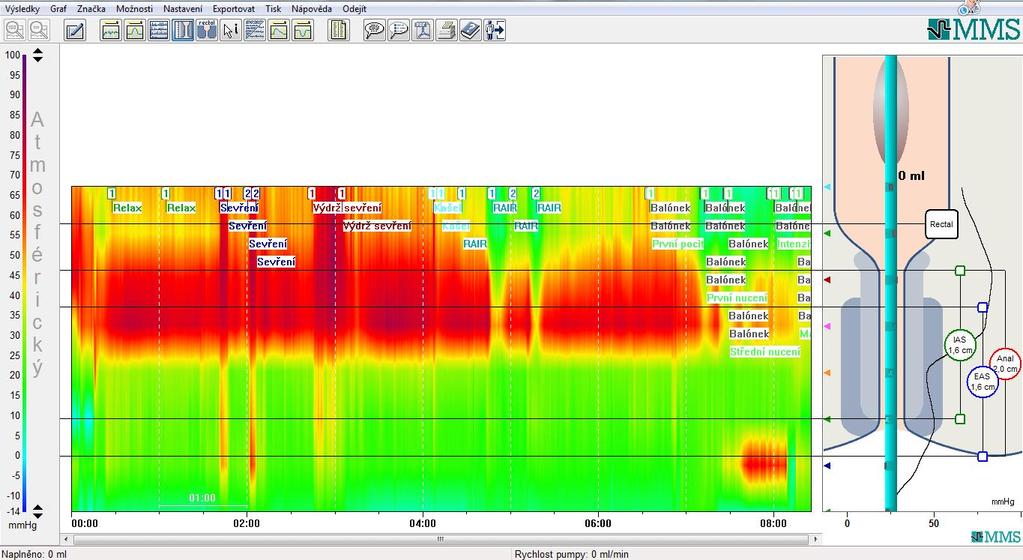highresolution manometrie před a po terapii