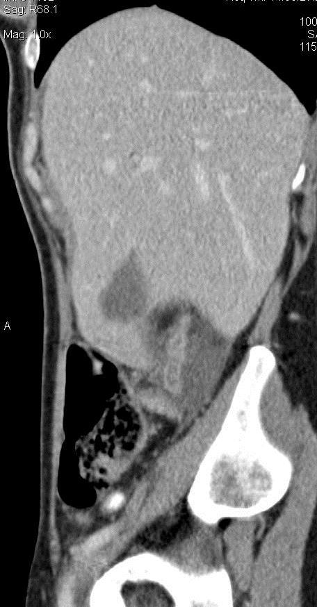 CT?