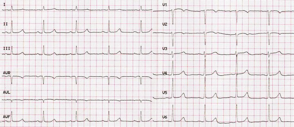 Po výkone: klinický stav stabilizovaný, bez stenokardii, TK 120/80 Kardiálne markery: hs-ctni... 9350.2...15636.