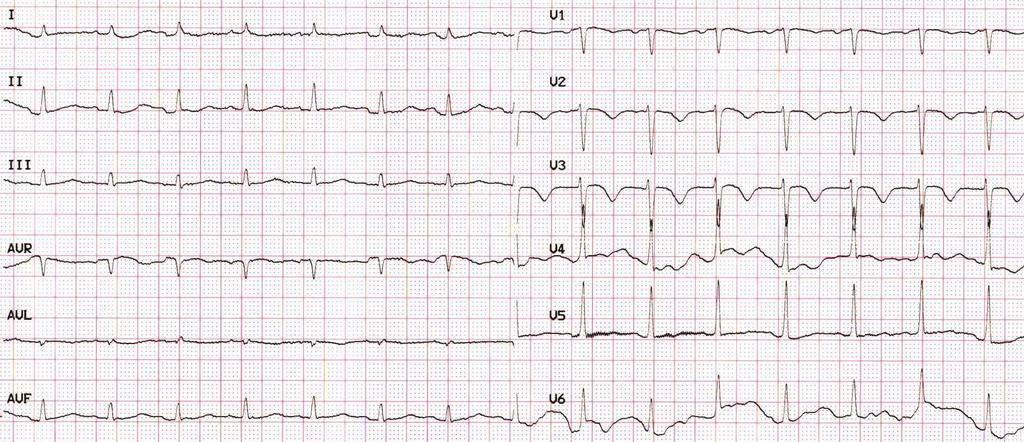 EKG pri prepustení 9. 12.
