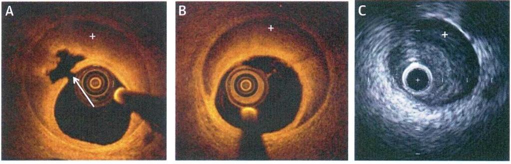 Diagnostika Koronarografia