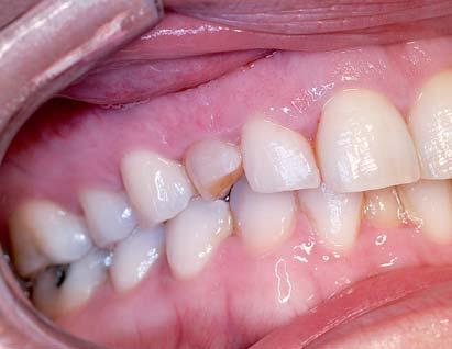 intervence za účelem uzavření diastematu prostřednictvím korunky nesené implantátem.