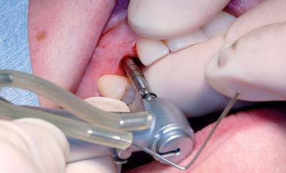 8: Odebraná kost byla kondenzovaná kolem implantátu užitím systému Dentak K Obr. 3 Obr. 4 Obr. 5 Obr. 6 využít implantátu 12 2,8 mm s Morseovým kónusem o délce 4 mm a rozšiřováním 1,50.