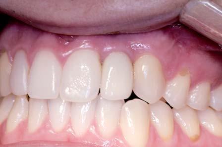 Závěr a diskuze V roce 2013 jsem inzeroval první implantát s průměrem 2,8 mm.