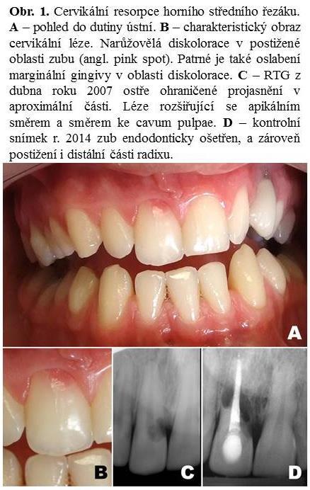 ETIOPATOGENEZE VNĚJŠÍCH CERVIKÁLNÍCH RESORPCÍ Autor: Barbora Hocková Výskyt Invazivní cervikální resorpce (ICR) je jev, vyskytující se velmi vzácně, přibližně u 0,02% populace.