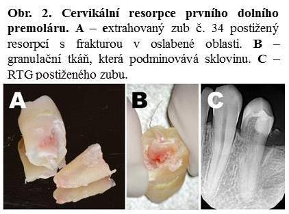 reakcí organismu na akutní případně chronické poškození periodontia.