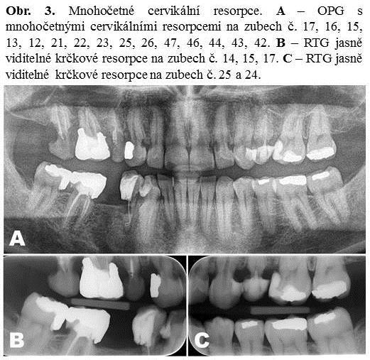 granulační tkání. 4 V počáteční fázi vývoje resorpčních dutina obsahuje řadu vazivové tkáně, krevních cév a klastické resorpčních buňky.