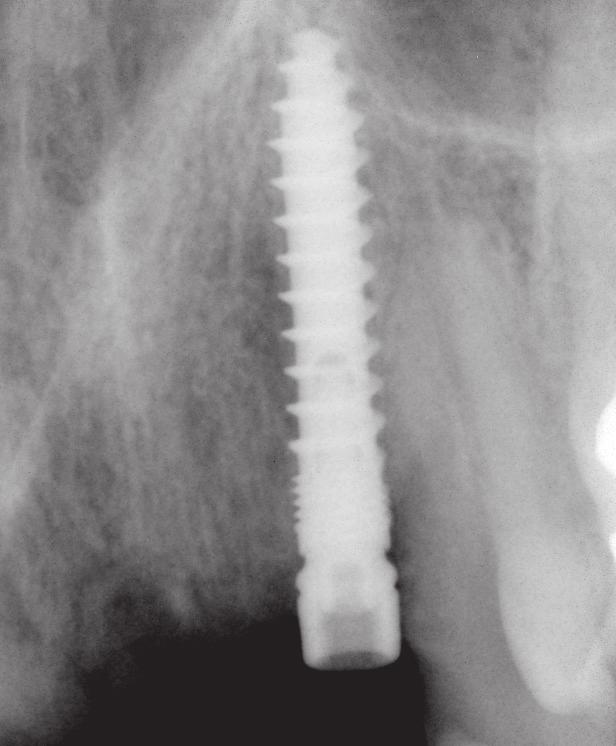 Rok 1962 je v implantologii spojen se jménem LINKOW, který vyvinul a zaváděl do alveolárních výběžků ploché plátkové čepelkové implantáty.