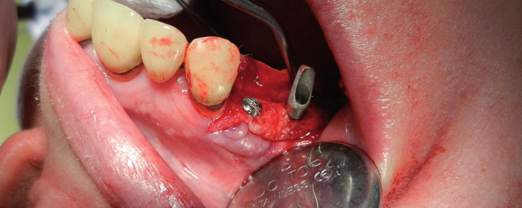 Obr. 1 Obr. 2 Obr. 3 Obr. 1: B1 plátkový implantát k okamžitému zatížení Obr. 2: Příklad jednofázového plátkového implantátu B1 Obr.