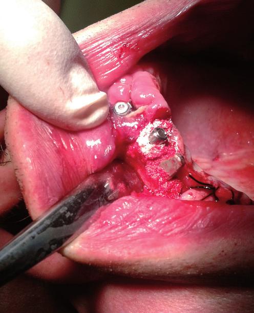 Tento typ implantátů se dá s pomocí ohýbacích kleští upravit do osy. Toto ohýbání se však musí vést mimo alveol a až takto upravený implantát se pomocí zatloukače usadí do kostní tkáně.