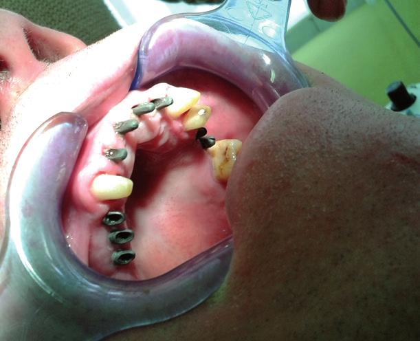 B2 dvoufázové plátkové implantáty, mají podobné využití jako implantáty typu B1, ale i přímou aplikaci do plošných extrakčních ran se zakotvením do neporušené části alveolu.