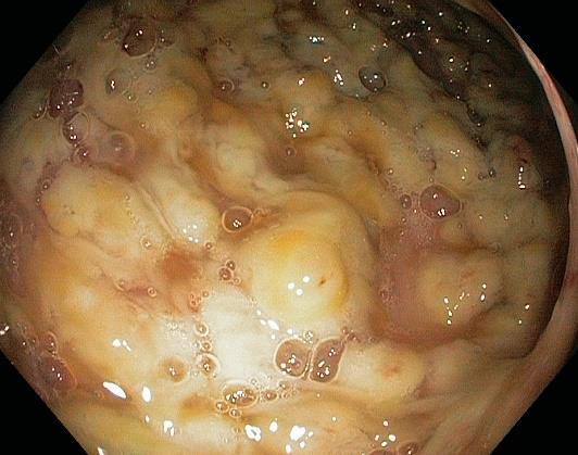 Klinické varianty onemocnění Asymptomatické nosičství Průjem s kolitidou Pseudomembranózní kolitida Fulminantní kolitida Až 50% iniciálních infekcí vznikne v komunitě!