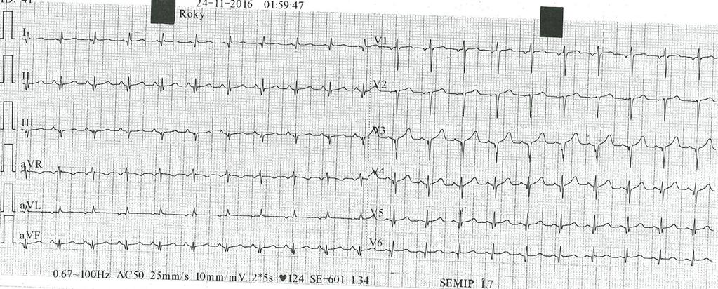 EKG 8 hod