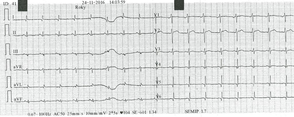 EKG 22 hod