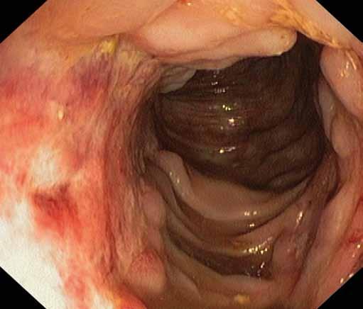 Léčba Hereditárny komplikované angioedém Crohnovy ako choroby príčina vedolizumabem bolestí brucha Obr. 3.