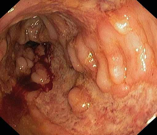 Endoscopic image of high inflammatory activity in the colon, stenotic lumen (deep ulcer predominantly in sigmoideum), not accessible with endoscope because of a high risk of perforation.