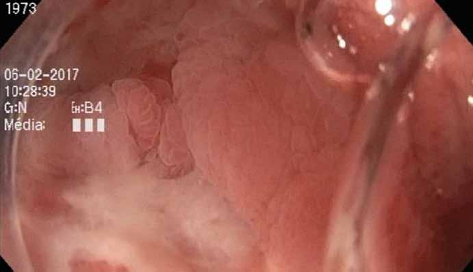 Hereditárny Léčba komplikované angioedém Crohnovy ako príčina choroby bolestí vedolizumabem brucha Obr. 6. Neoterminální ileum s klidovým nálezem po 5měsíční léčbě vedolizumabem. Fig. 6. Healed neoterminal ileum with finding after 5 months of treatment with vedolizumab.