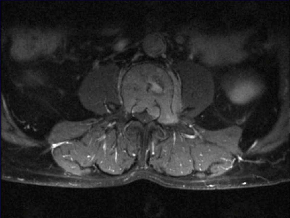 Zobrazovací metody - MRI posouzení vztahu tumoru k míše, kořenům, měkkým tkáním mediastina, břicha před NCh zákrokem, radioterapií detekce u 1/3 nemocných s negativitou RTG další,