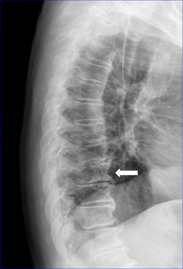 Zobrazovací metody - RTG osteolytická, vzácně