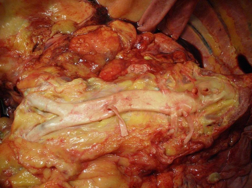 Břišní aorta: anatomie