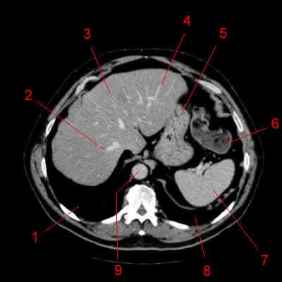 Břišní aorta: anatomie CT Nekontrastní CT