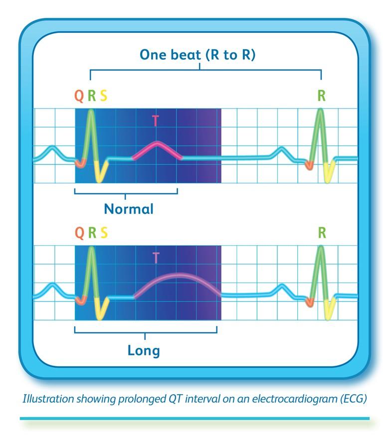 Jak odhadnout QT interval?