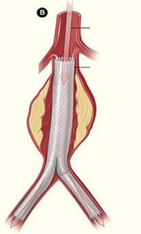 ml 0,5% Marcaine + 20 ug Sufenta sedace propofol 1% 6-10 ml/hod při