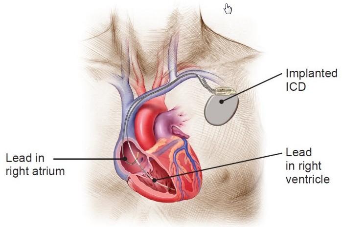 ICD implantabilní