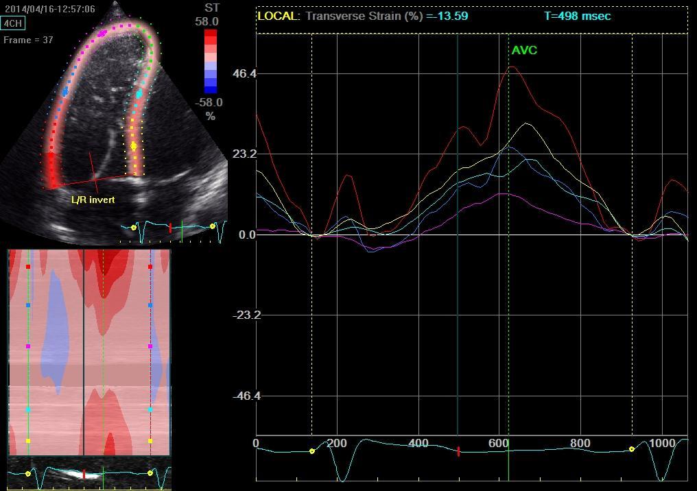 ms 6 měsíců po RV-CRT Synchronní kontrakce RV Septal to RV