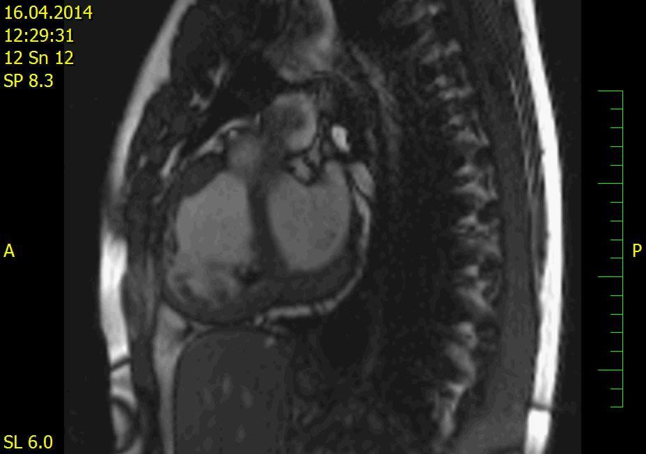 LV: EDV/ESV 63/28 ml/m2, EF 56 % Ergometrie - V0 2 max: před RV-CRT