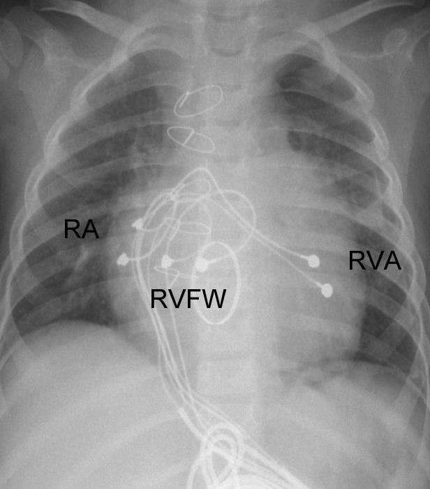 Pacientka HLHS Implantace bifokálního