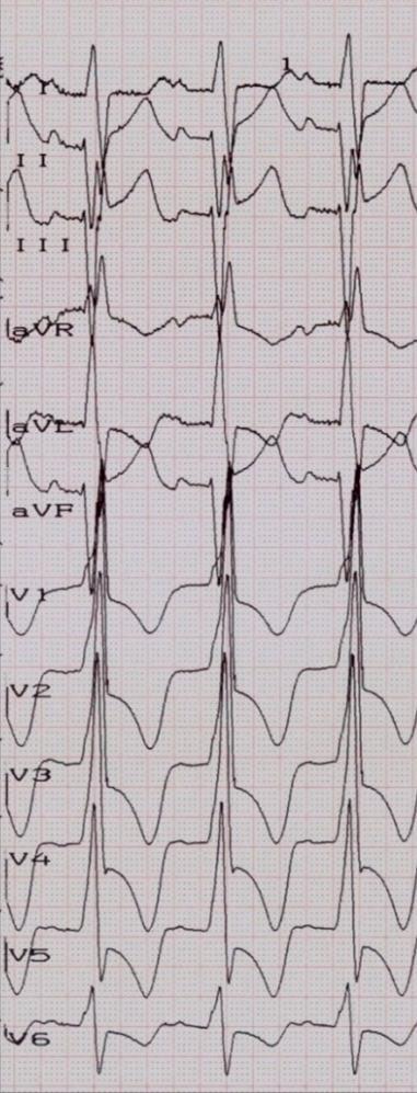 EKG Před CRT-sinus, AVB