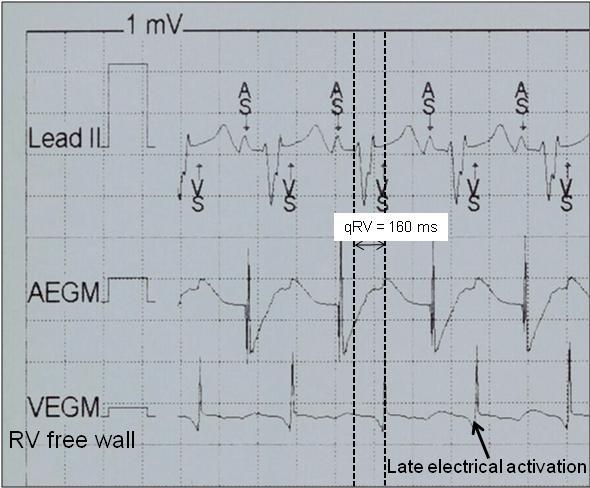 CRT sinus, fúze vlastní