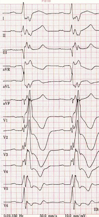 EKG Před CRT Sinus RBBB (QRS 200 ms) Po