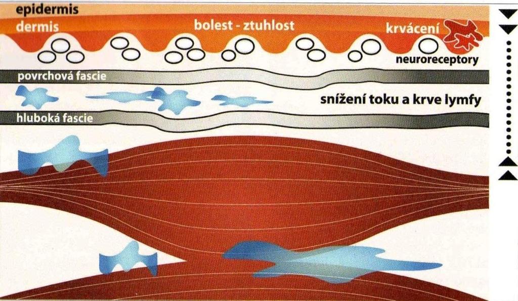 cirkulace, žilnímu městnání a k ischemii vyživovaných tkání.
