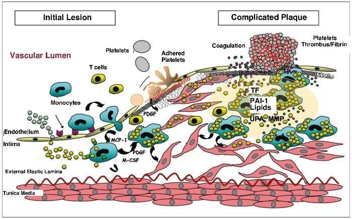 Obrázek 7: Patogeneze aterosklerózy http://www.revespcardiol.org/en/lipoproteins-platelets-and-atherothrombosis/articulo/131426