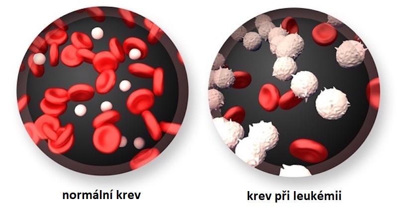 4 Onemocnění 4.1 Leukémie Leukémie je nádorové onemocnění postihující bílé krvinky neboli leukocyty. Toto onemocnění vychází z lymfatického systému (kostní dřeně).