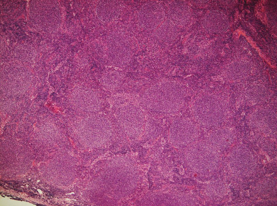 MICHALKA J. ET AL. Obr. 1. Folikulární lymfom G1, hematoxylin eosin, zvětšení 50x.